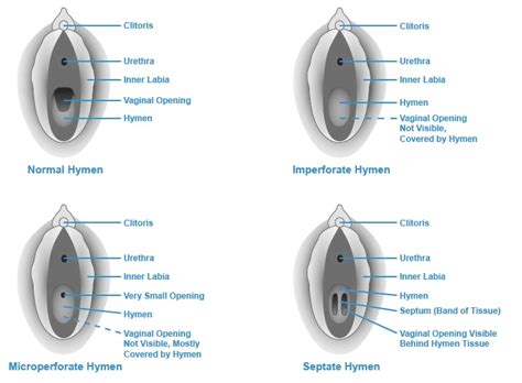 broken hymen|Hymen: Overview, Function & Anatomy